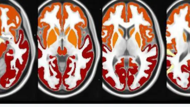  Using AI to optimize Tau PET Imaging for Alzheimer’s Disease Clinical Development